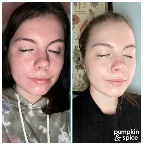 Pumpkin Seed Oil For Redness Results